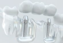 Bright Harbor: A Patient’s Guide to Restorative Dentistry in Seattle