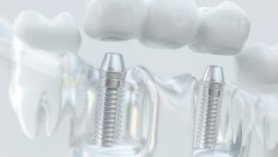 Bright Harbor: A Patient’s Guide to Restorative Dentistry in Seattle